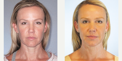 Eyelid Surgery before and after photo