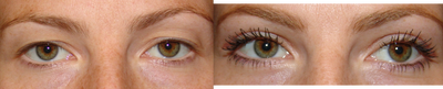 Eyelid Surgery before and after photo