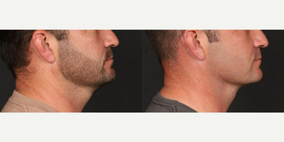 Neck Lift before and after photo