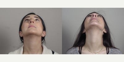 Rhinoplasty before and after photo