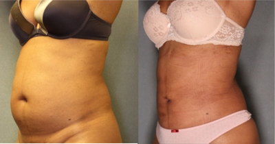 Smart Lipo before and after photo