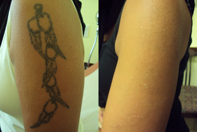 Tattoo Removal before and after photo