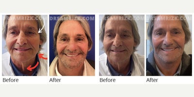 Deep Plane Facelift before and after photo