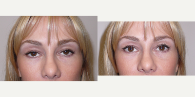 Eyelid Surgery before and after photo