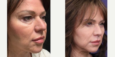 Eyelid Surgery before and after photo