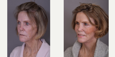 Facelift before and after photo
