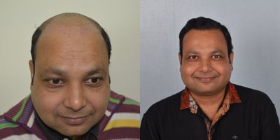 Hair Transplant before and after photo