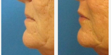 Lip Implants before and after photo