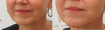 Dermal Fillers before and after photo