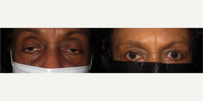 Ptosis Surgery before and after photo