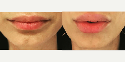 Dermal Fillers before and after photo