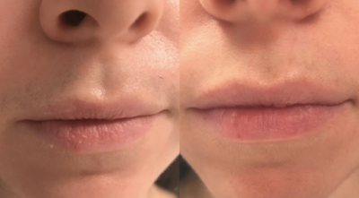 Laser Hair Removal before and after photo