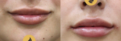 Lip Fillers before and after photo