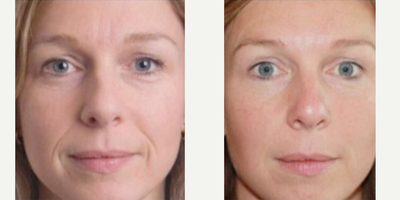 Radiesse before and after photo