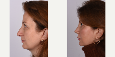 Rhinoplasty before and after photo