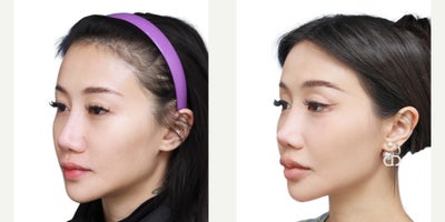 Asian Rhinoplasty before and after photo
