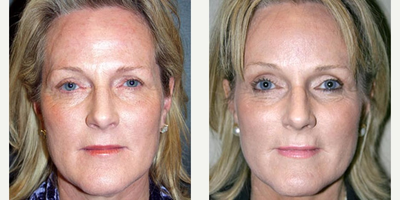 Brow Lift before and after photo