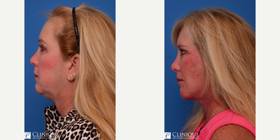 Chin Implant before and after photo