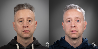 Eyelid Surgery before and after photo