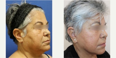 Facelift before and after photo