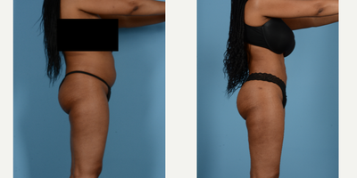 Liposuction before and after photo