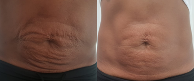 Plasma Fibroblasting before and after photo