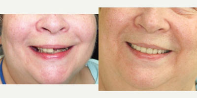 Smile Makeover before and after photo
