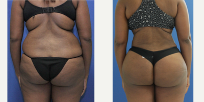 Brazilian Butt Lift before and after photo