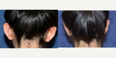 Ear Surgery before and after photo
