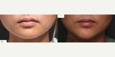 Dermal Fillers before and after photo