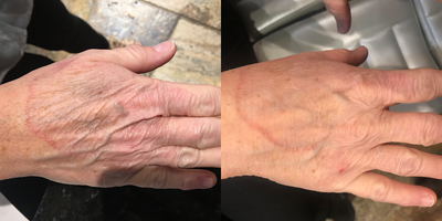Hand Rejuvenation before and after photo