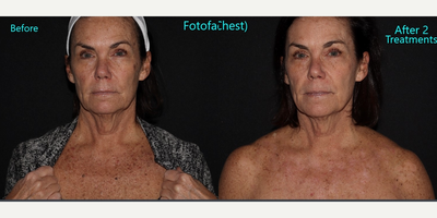IPL before and after photo
