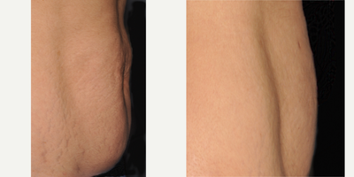 ThermiTight before and after photo
