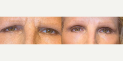 Botox before and after photo