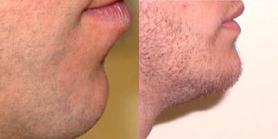 Chin Implant before and after photo