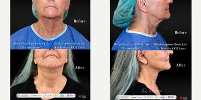 Deep Plane Facelift before and after photo