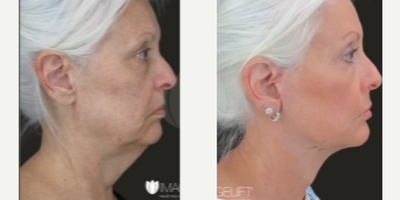 Dermal Fillers before and after photo