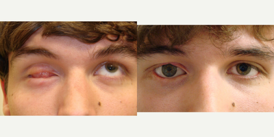 Facial Reconstructive Surgery before and after photo