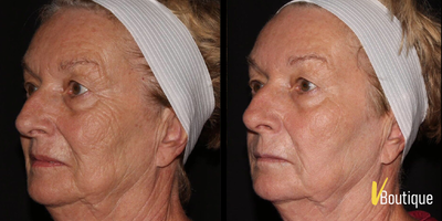 Fractional Laser before and after photo