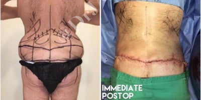 Liposuction before and after photo