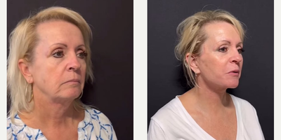 Neck Lift before and after photo
