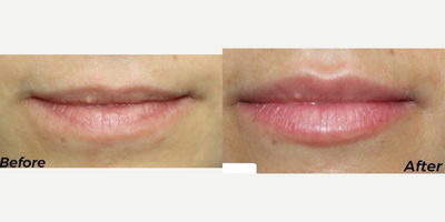 Revanesse before and after photo