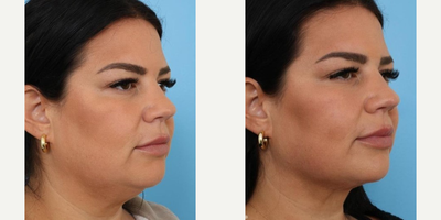 Chin Liposuction before and after photo