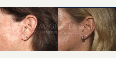 Facelift before and after photo