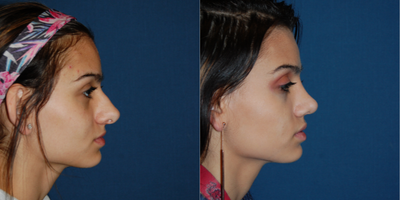 Rhinoplasty before and after photo