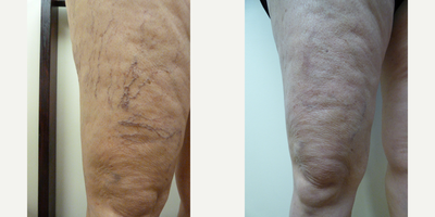 Sclerotherapy before and after photo