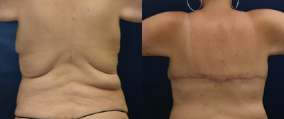 Body Lift before and after photo