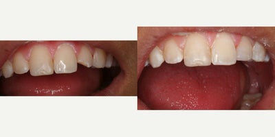 Dental Bonding before and after photo