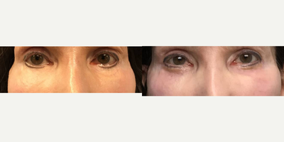 Eyelid Retraction Repair before and after photo