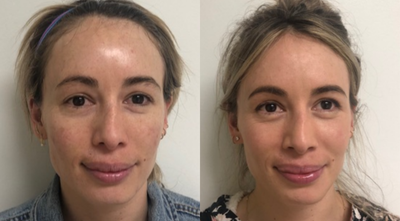 Fraxel Laser before and after photo
